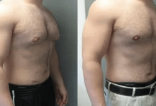 Gynecomastia