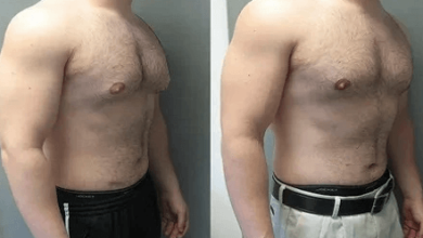 Gynecomastia