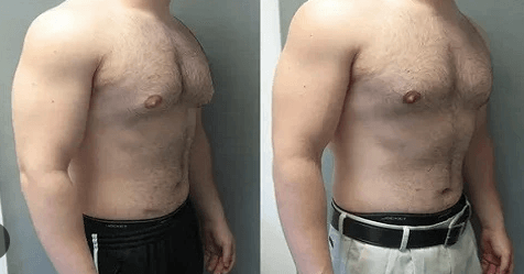 Gynecomastia